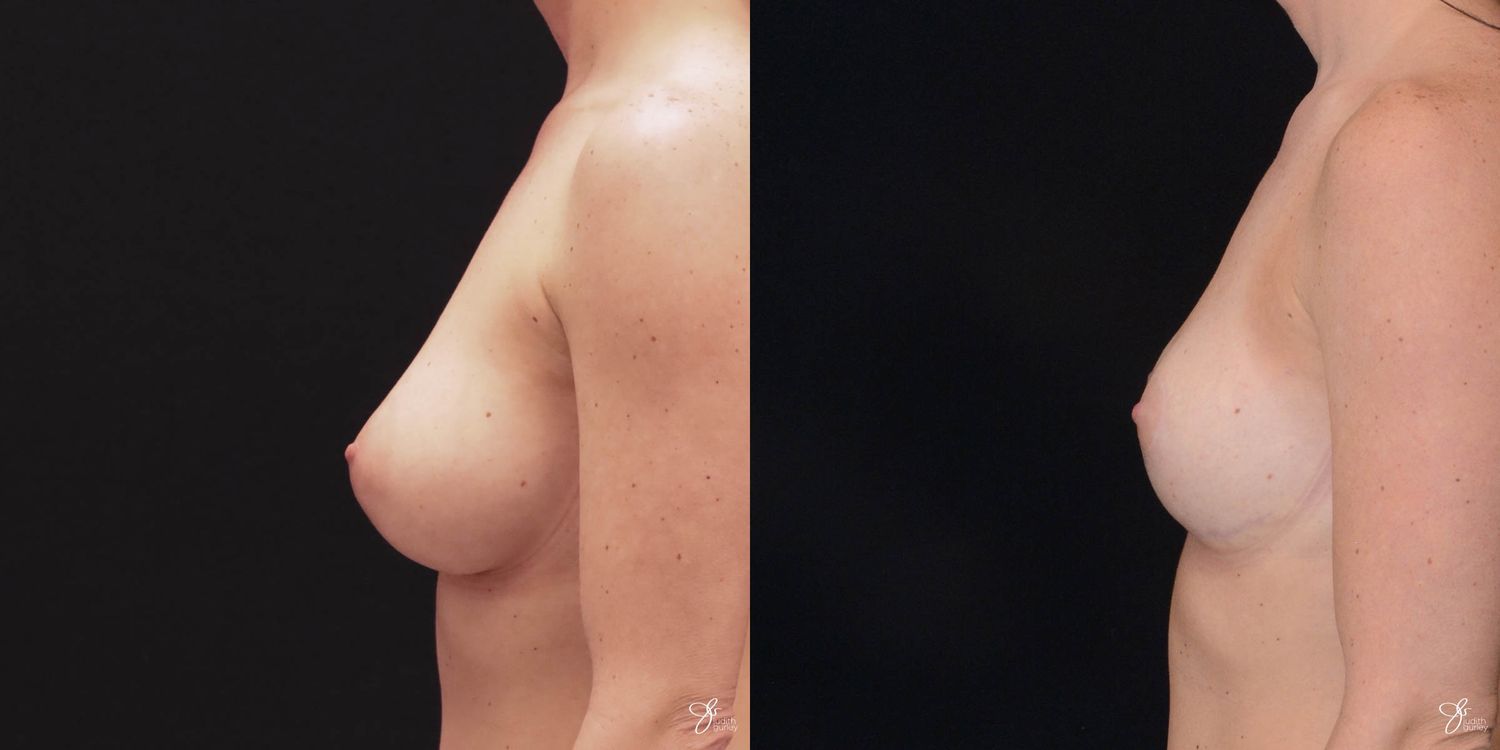 Breast Reduction Before & After