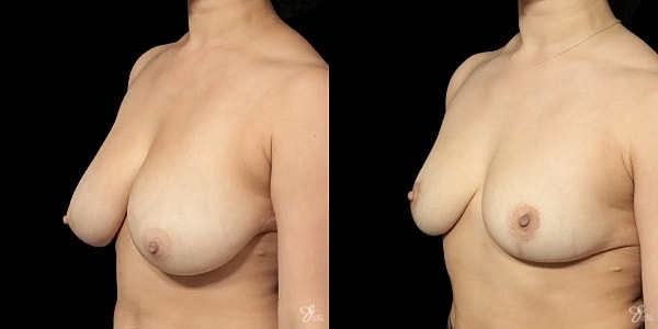 Breast Reduction Before & After