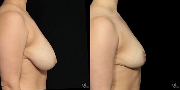 Breast Reduction Before & After