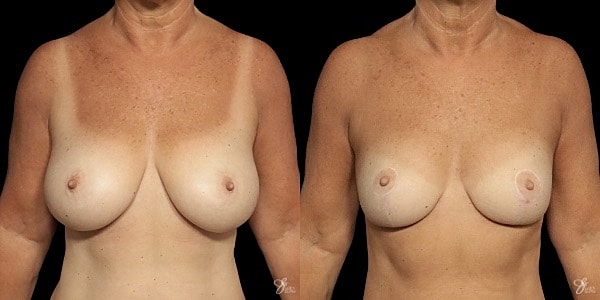 Breast Reduction Before & After