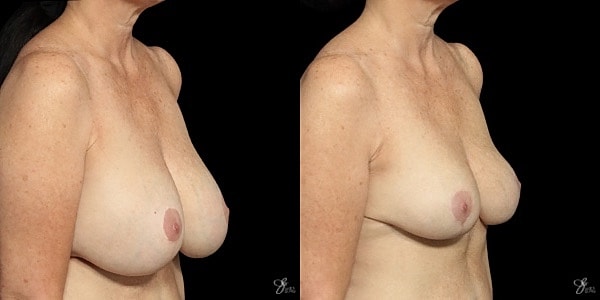 Breast Reduction Before & After