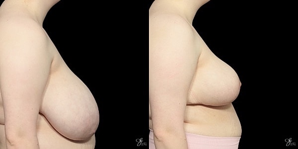 Breast Reduction Before & After