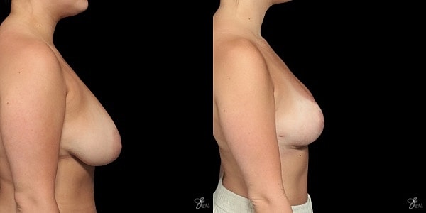 Breast Reduction Before & After