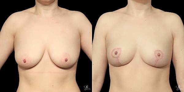 Breast Reduction Before & After