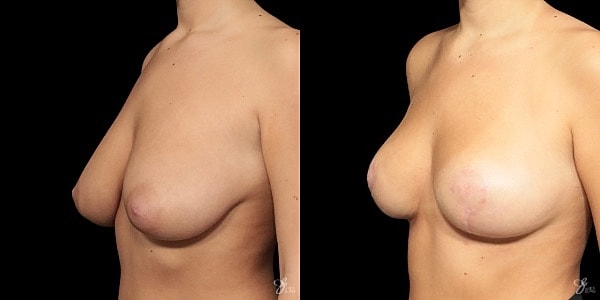 Breast Reduction Before & After