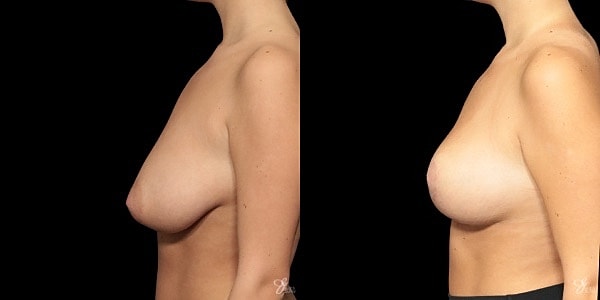 Breast Reduction Before & After