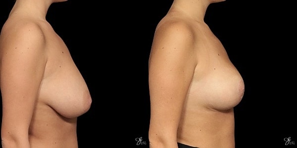 Breast Reduction Before & After