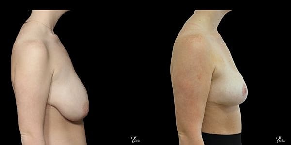 Breast Reduction Before & After