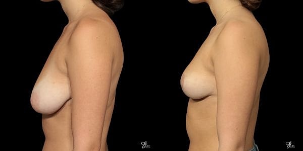Breast Reduction Before & After