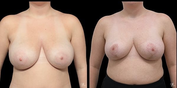 Breast Reduction Before & After