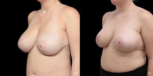 Breast Reduction Before & After