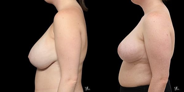 Breast Reduction Before & After