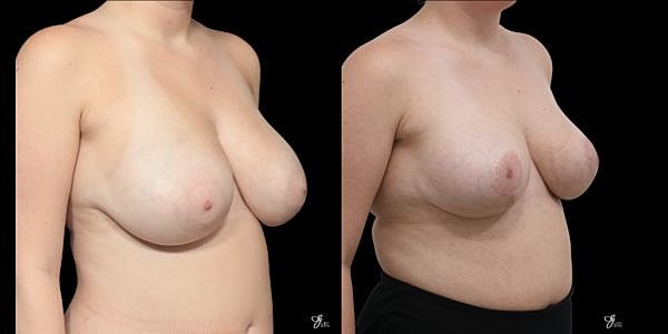 Breast Reduction Before & After
