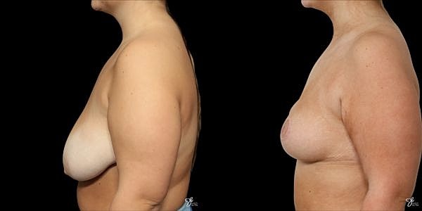 Breast Reduction Before & After