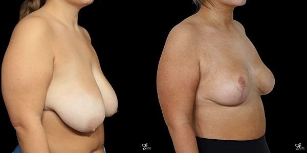 Breast Reduction Before & After
