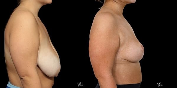 Breast Reduction Before & After