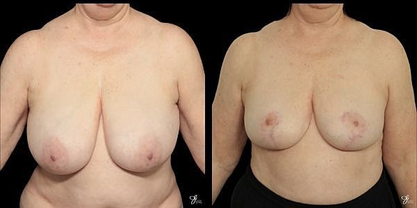 Breast Reduction Before & After