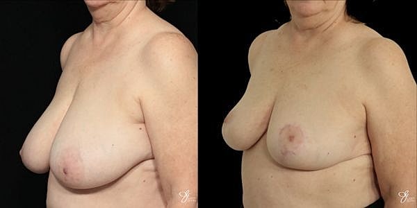 Breast Reduction Before & After