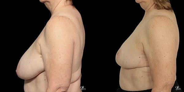 Breast Reduction Before & After