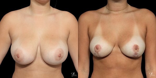 Breast Reduction Before & After