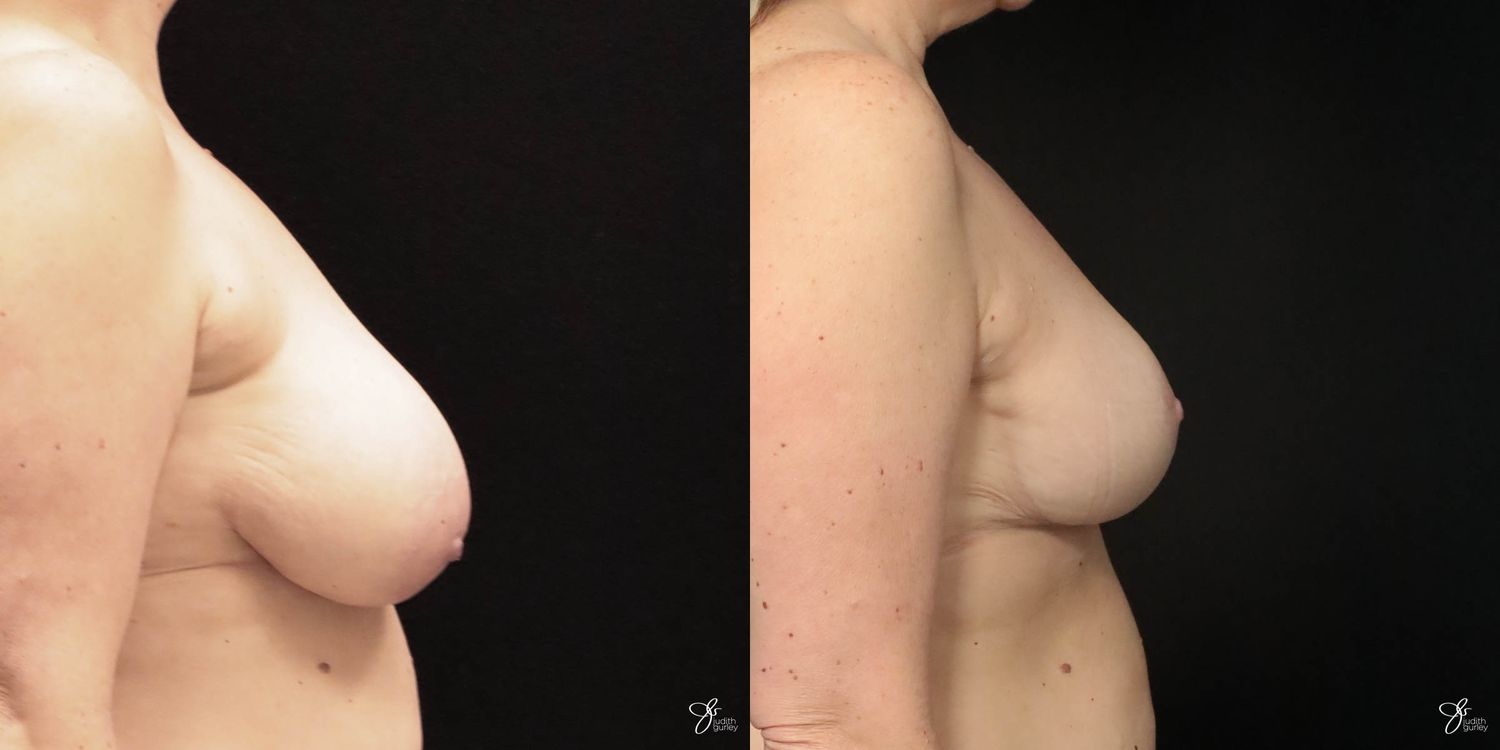 Breast Reduction Before & After