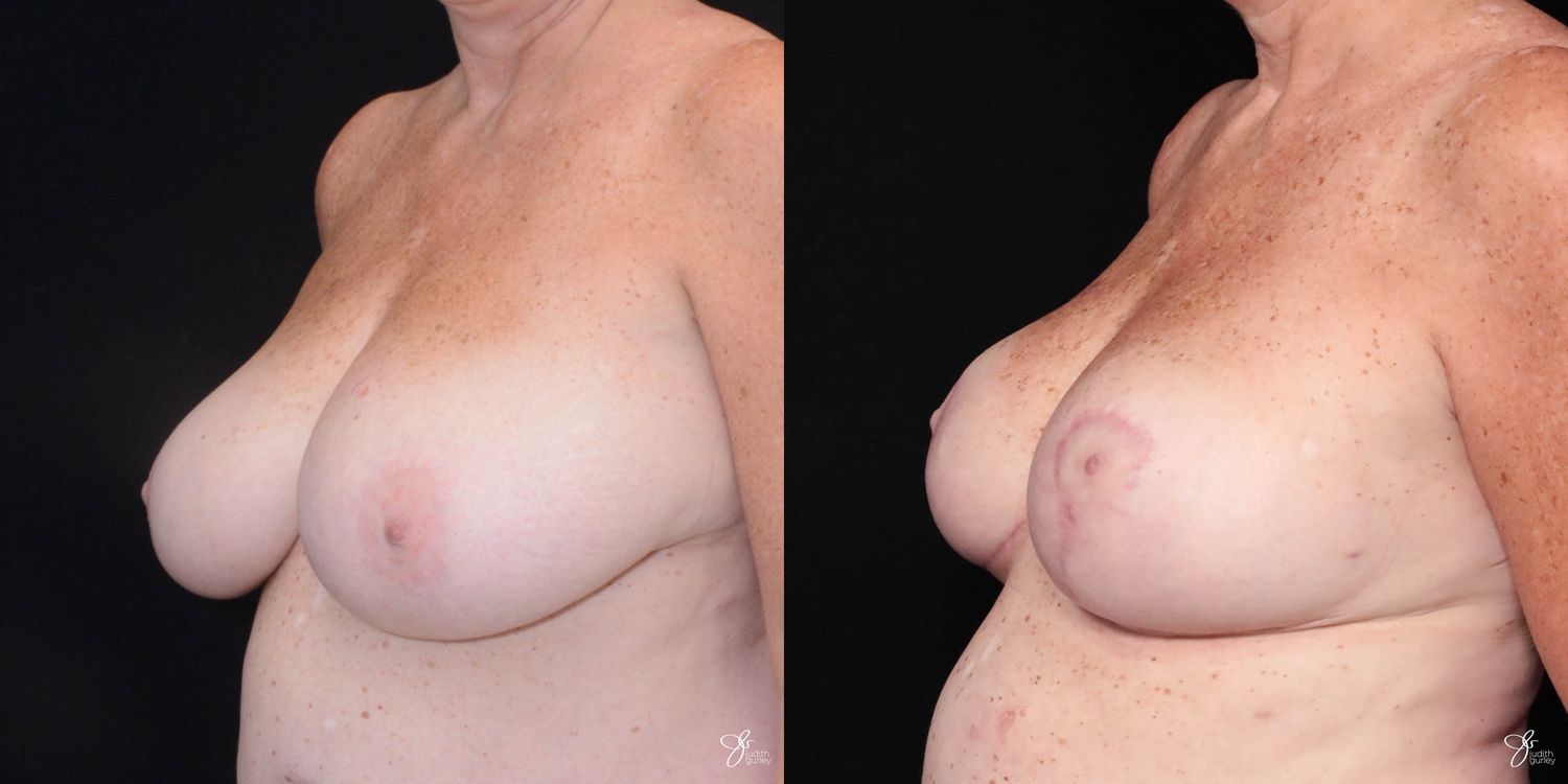 Breast Reduction Before & After