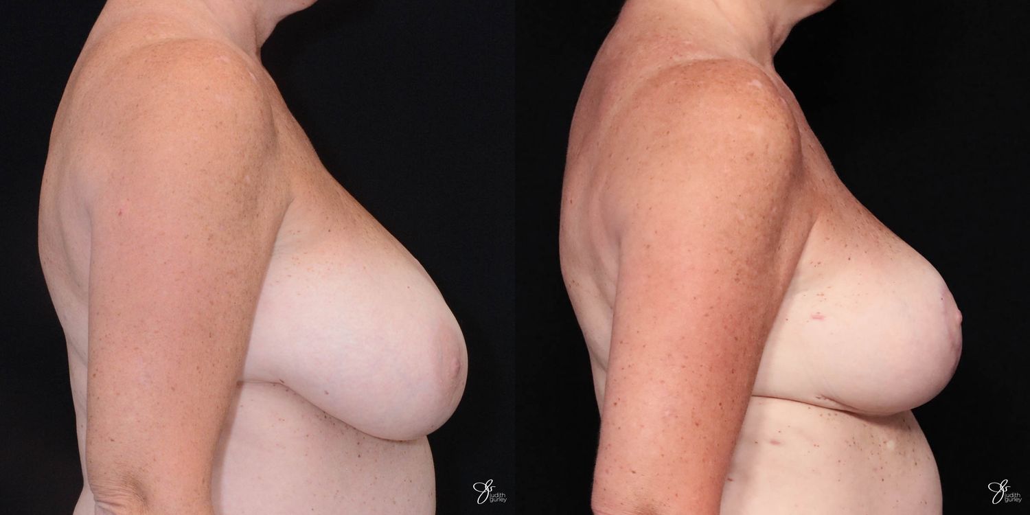 Breast Reduction Before & After