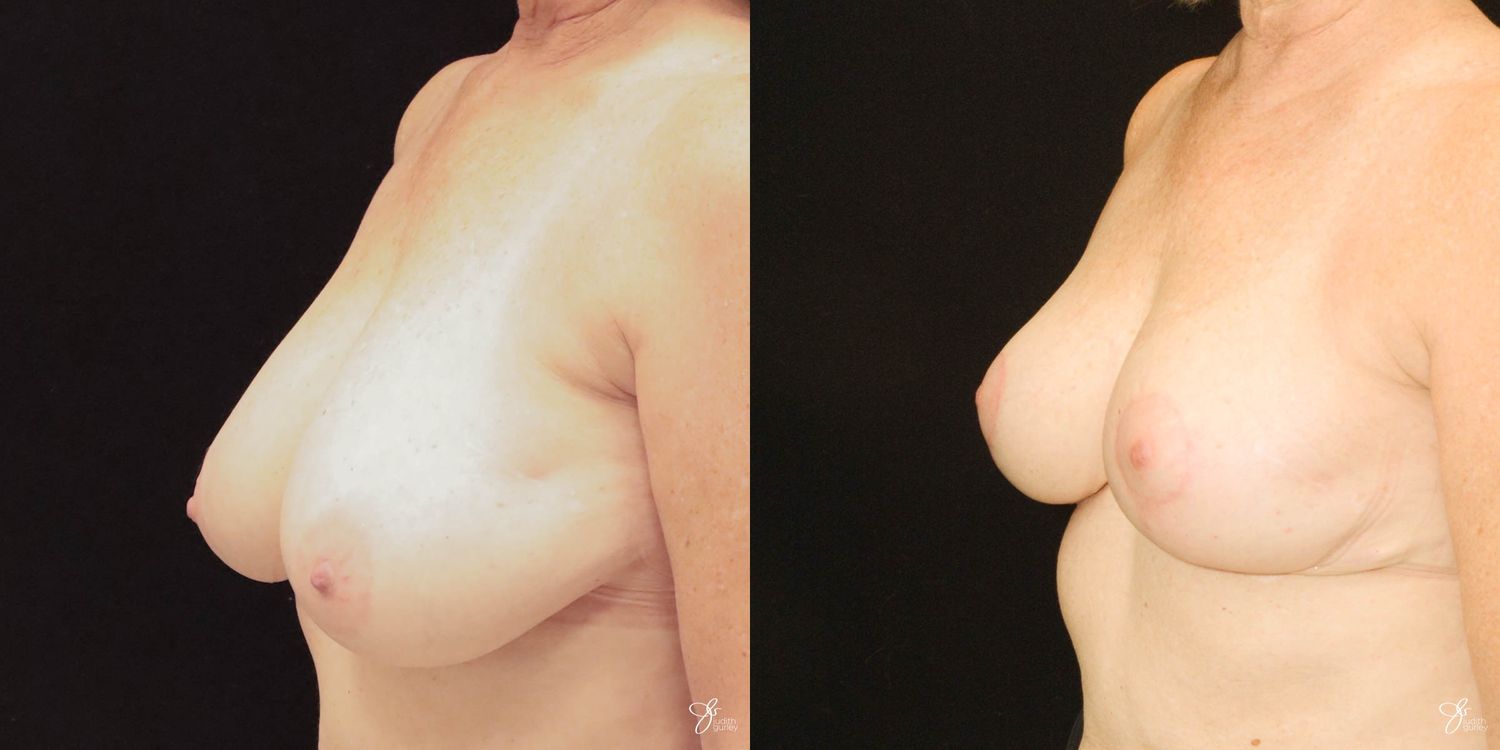 Breast Reduction Before & After