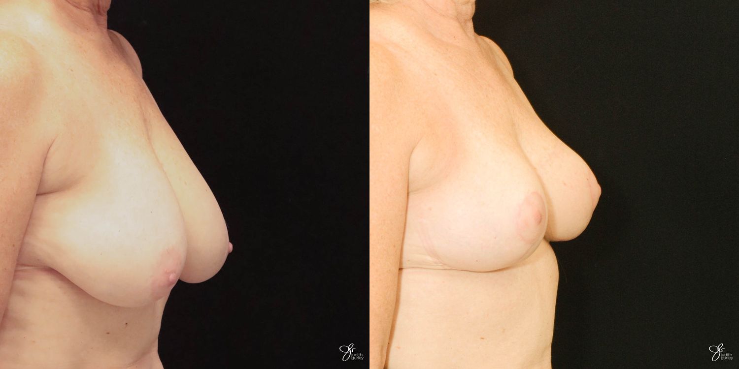 Breast Reduction Before & After