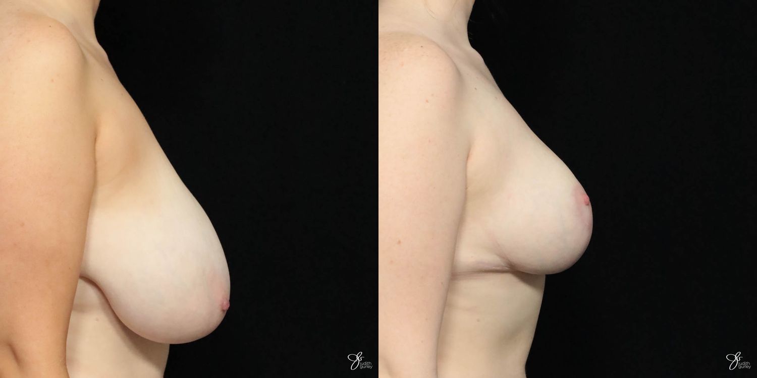 Breast Reduction Before & After
