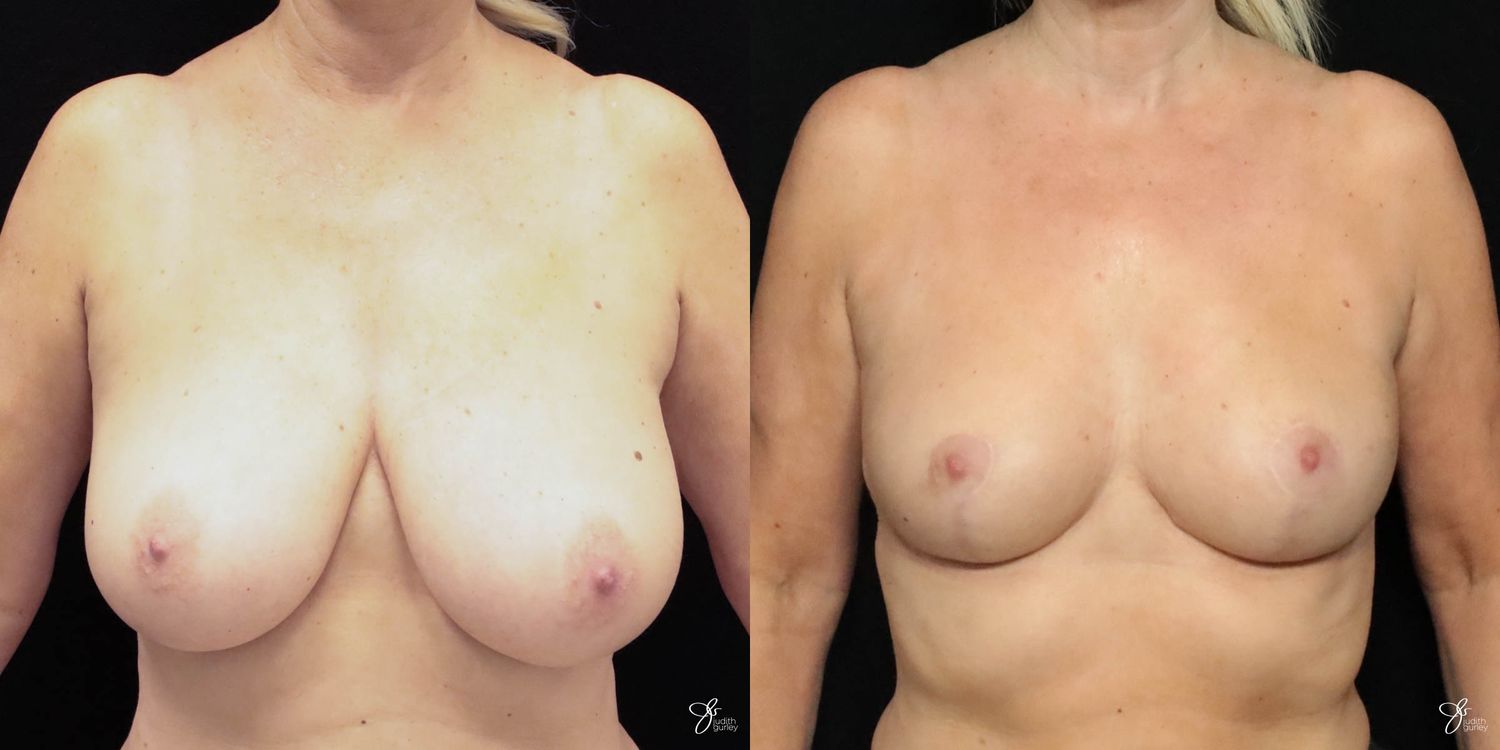 Breast Reduction Before & After