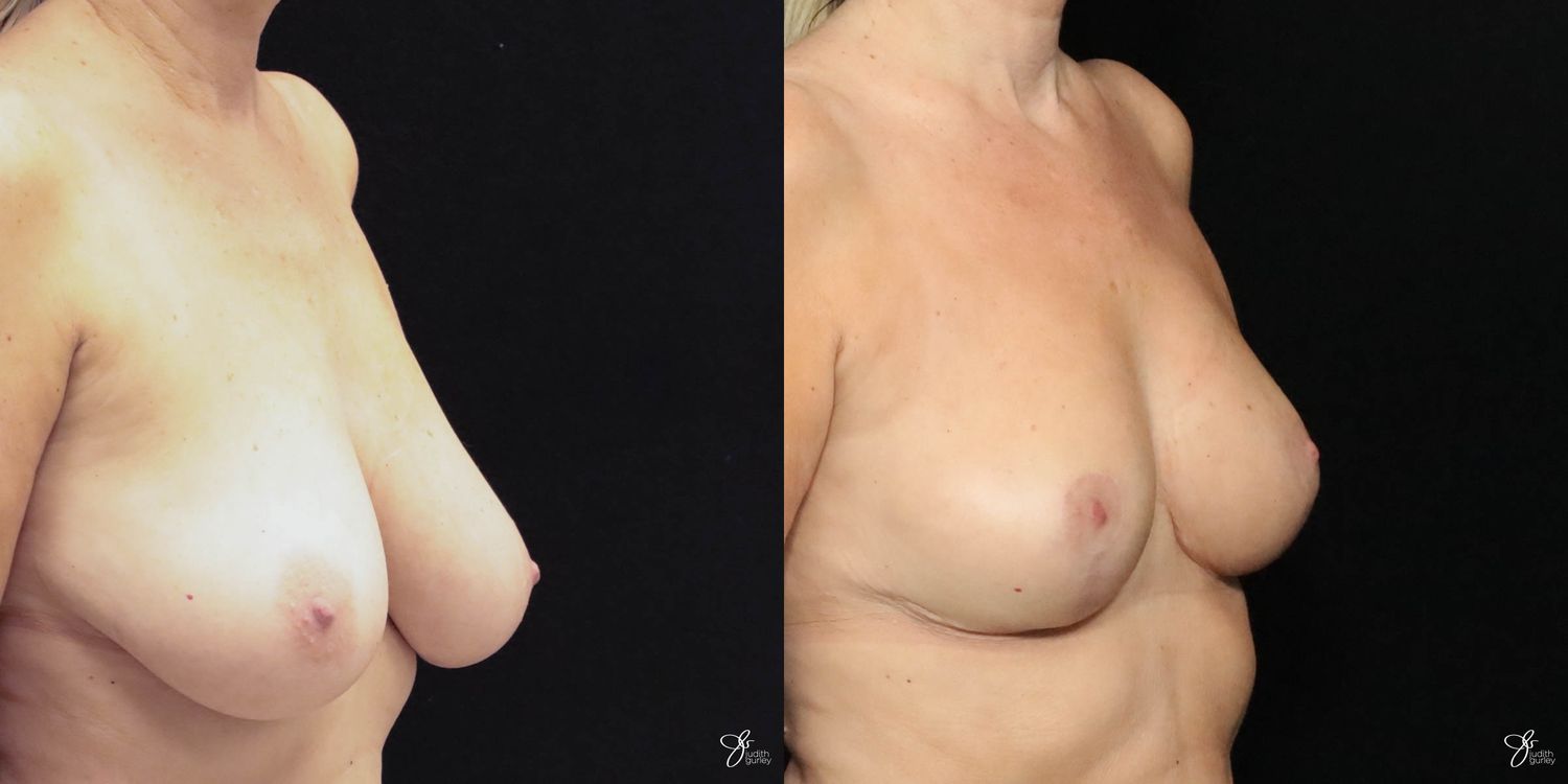 Breast Reduction Before & After