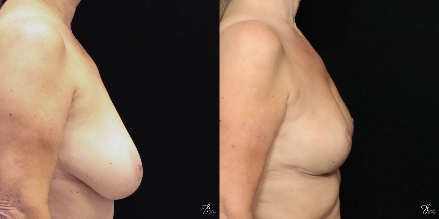 Breast Reduction Before & After