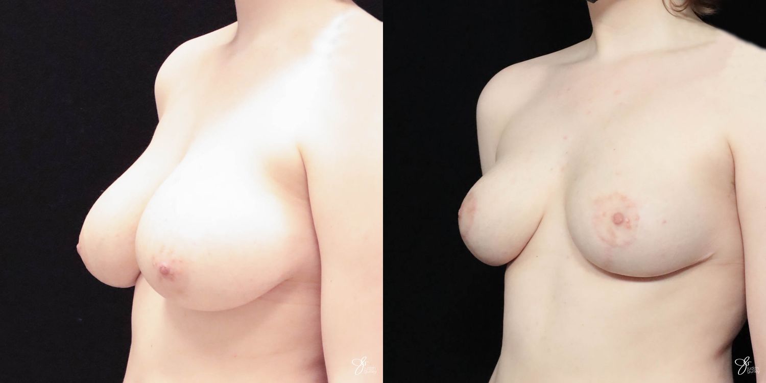 Breast Reduction Before & After