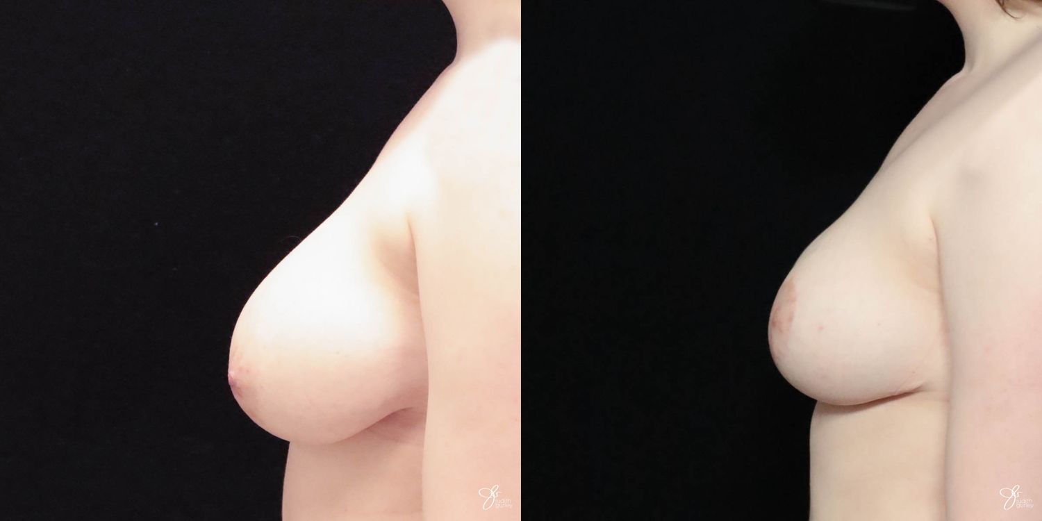 Breast Reduction Before & After