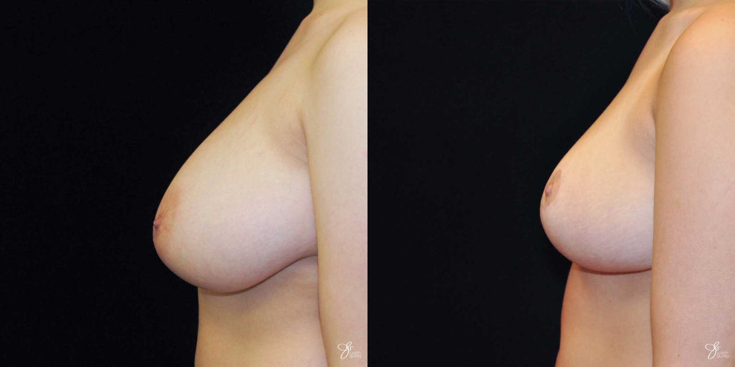 Breast Reduction Before & After