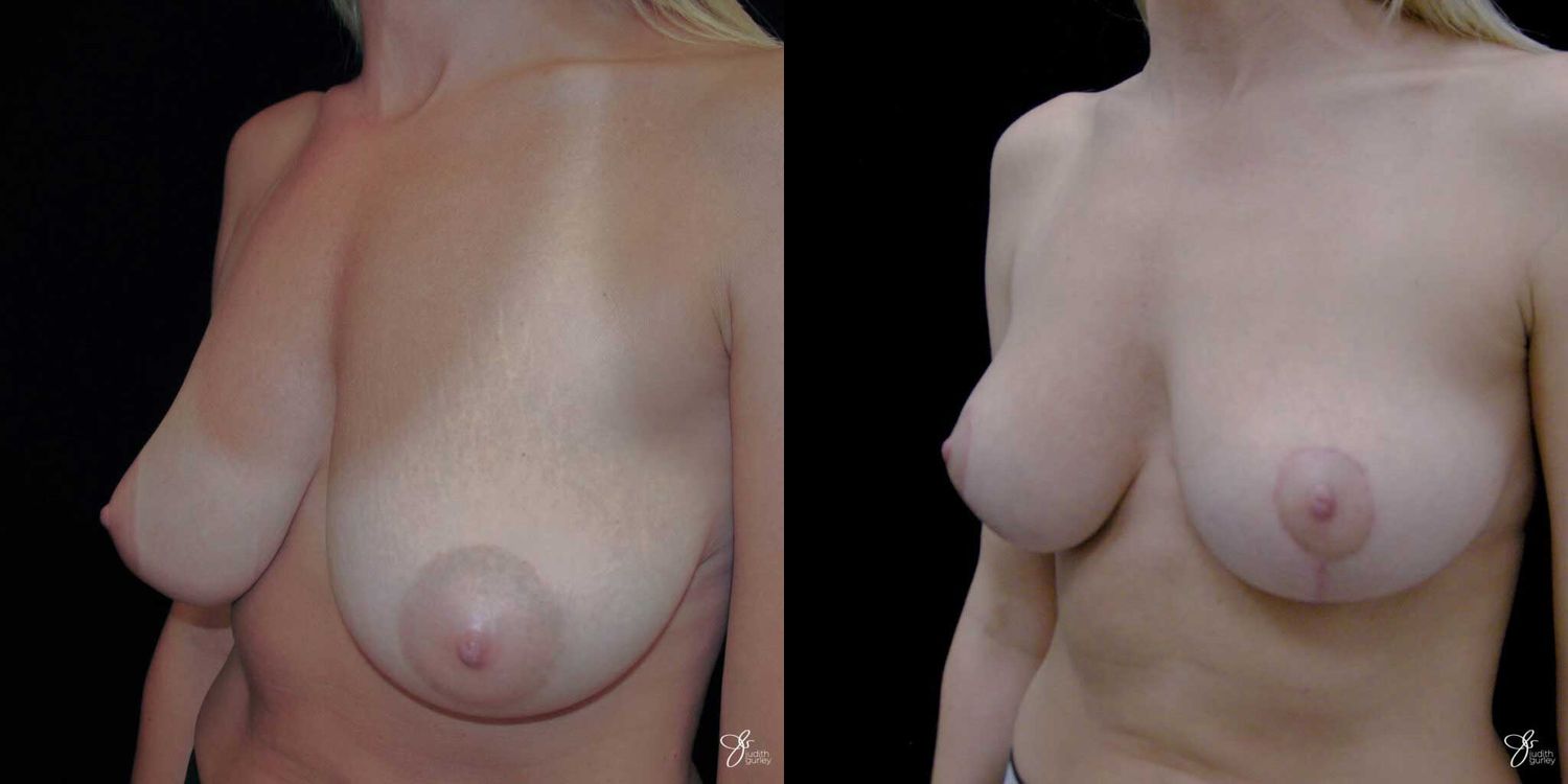Breast Reduction Before & After