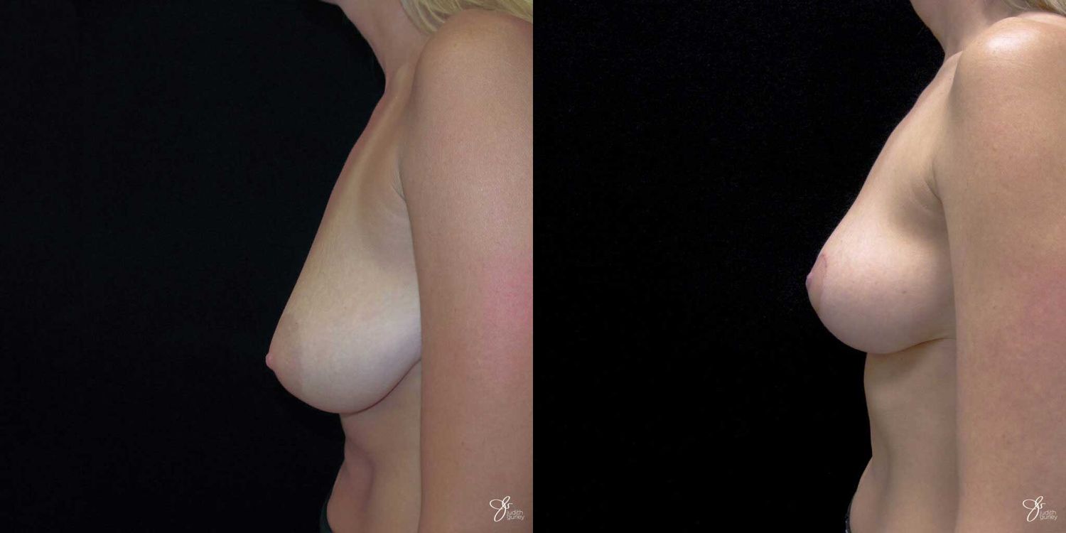 Breast Reduction Before & After