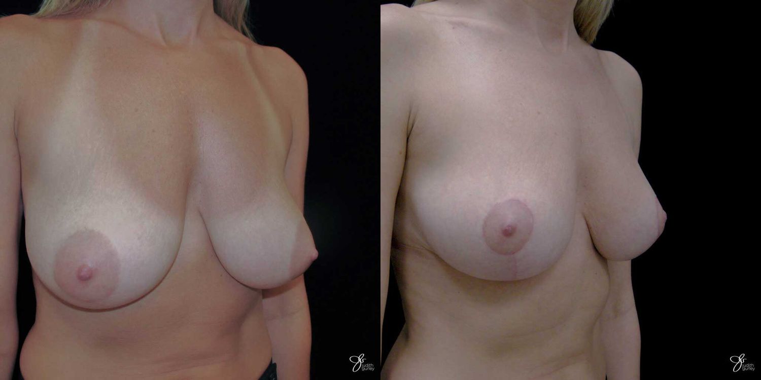 Breast Reduction Before & After