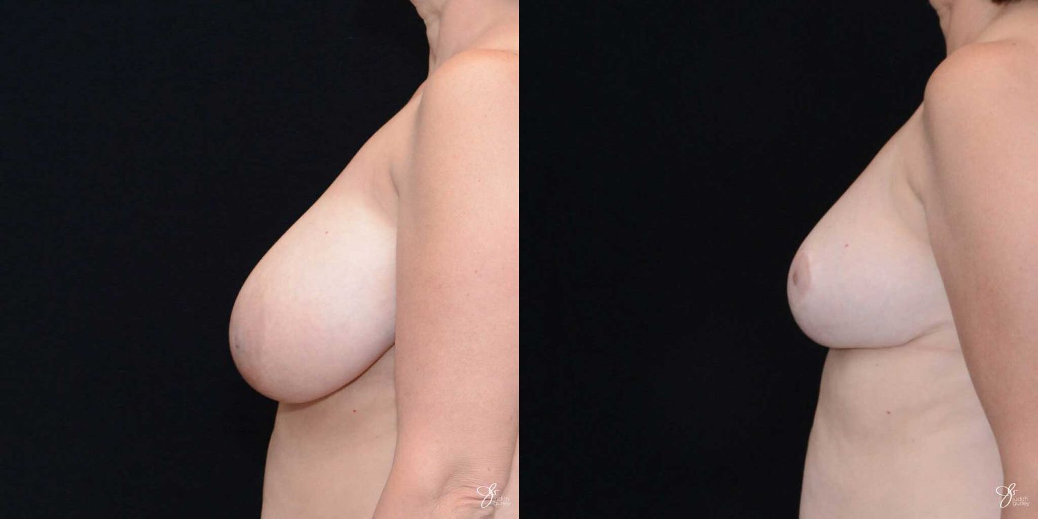 Breast Reduction Before & After