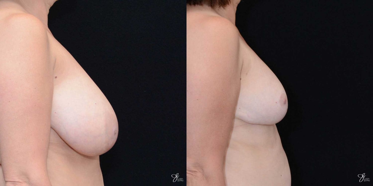 Breast Reduction Before & After