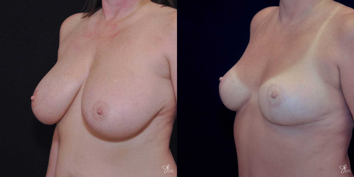 Breast Reduction Before & After