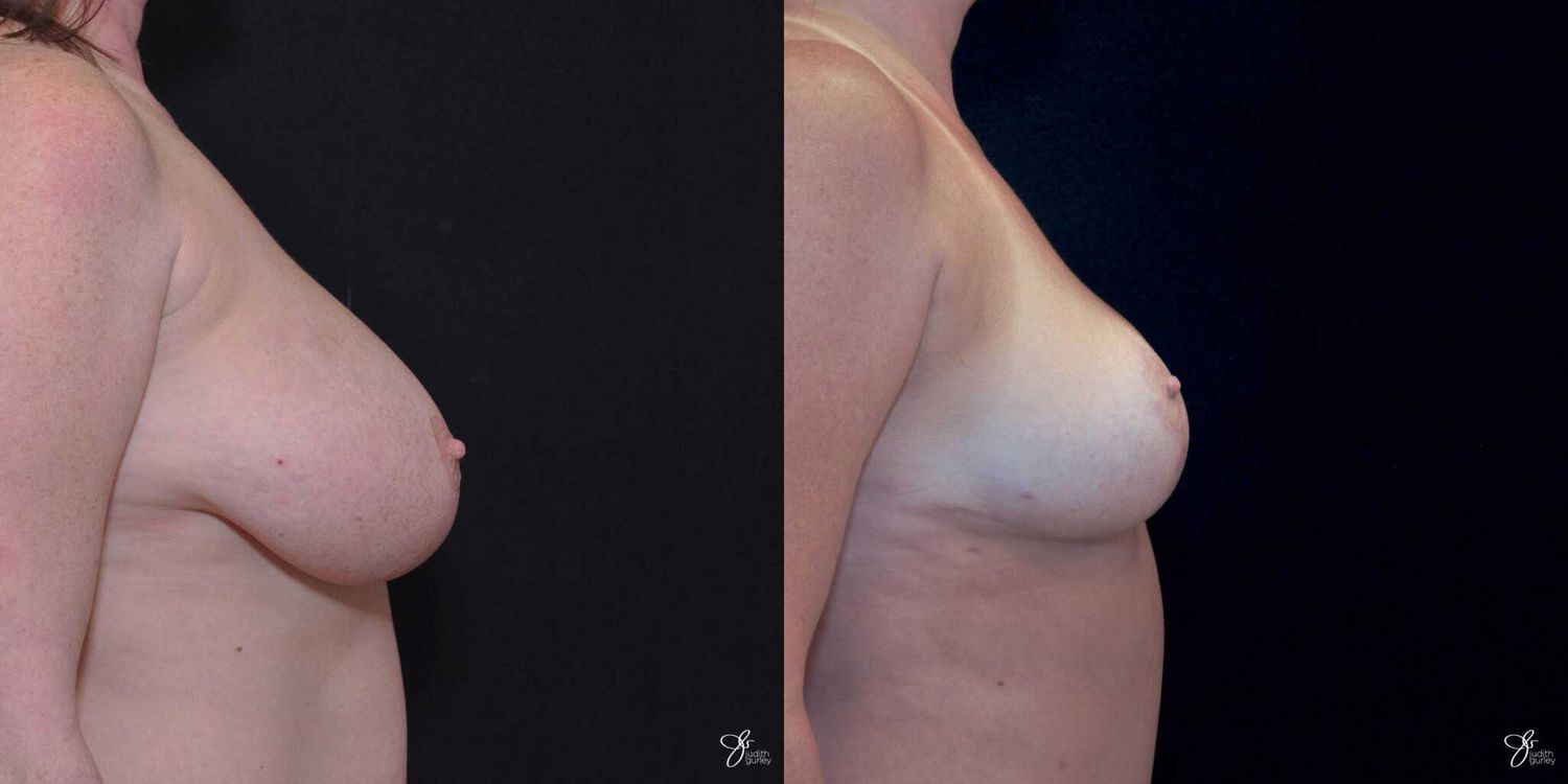 Breast Reduction Before & After