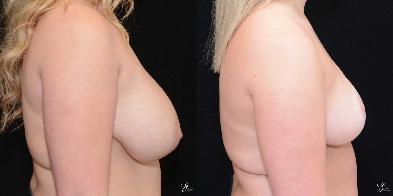 Breast Reduction Before & After