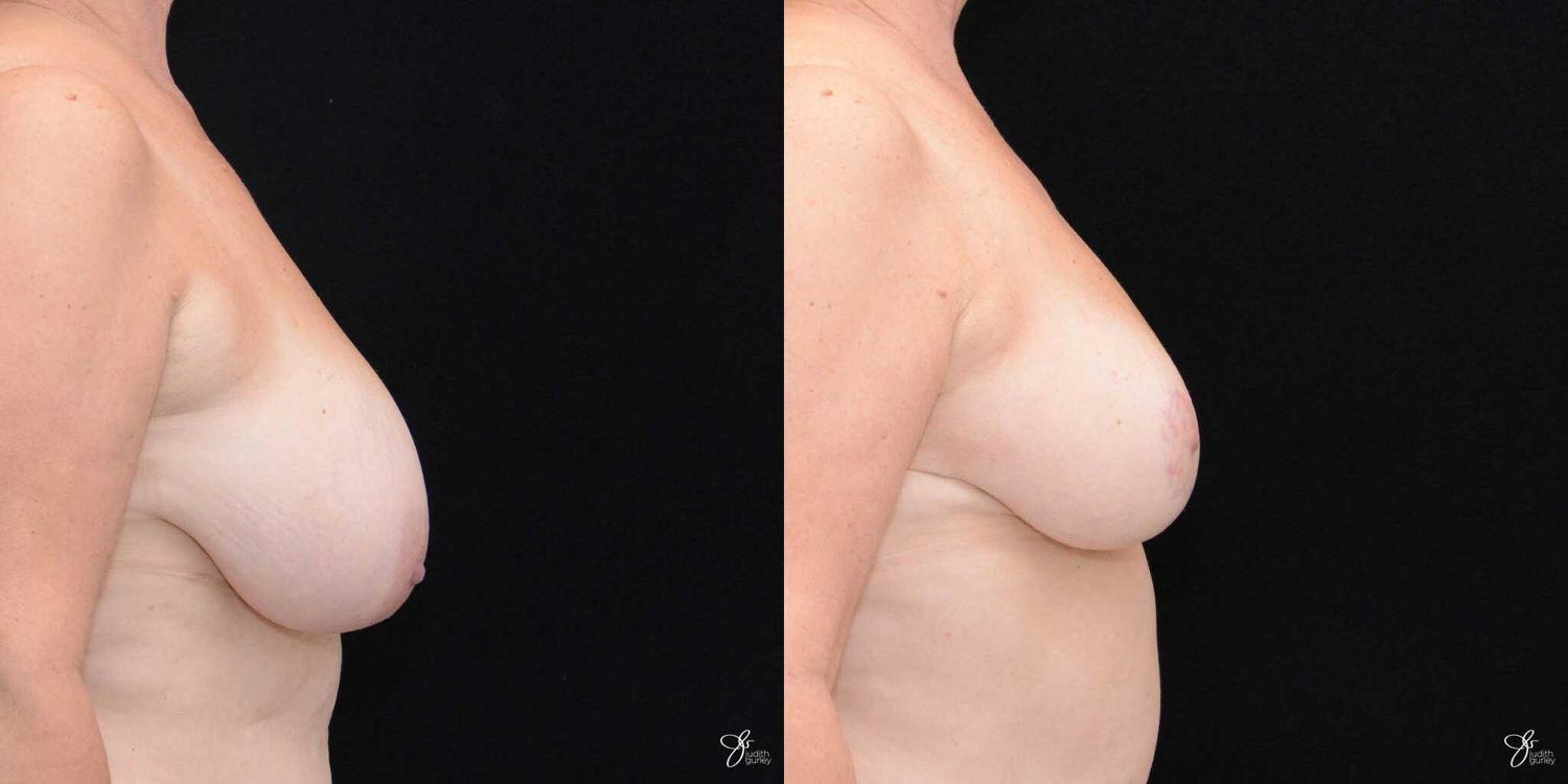 Breast Reduction Before & After