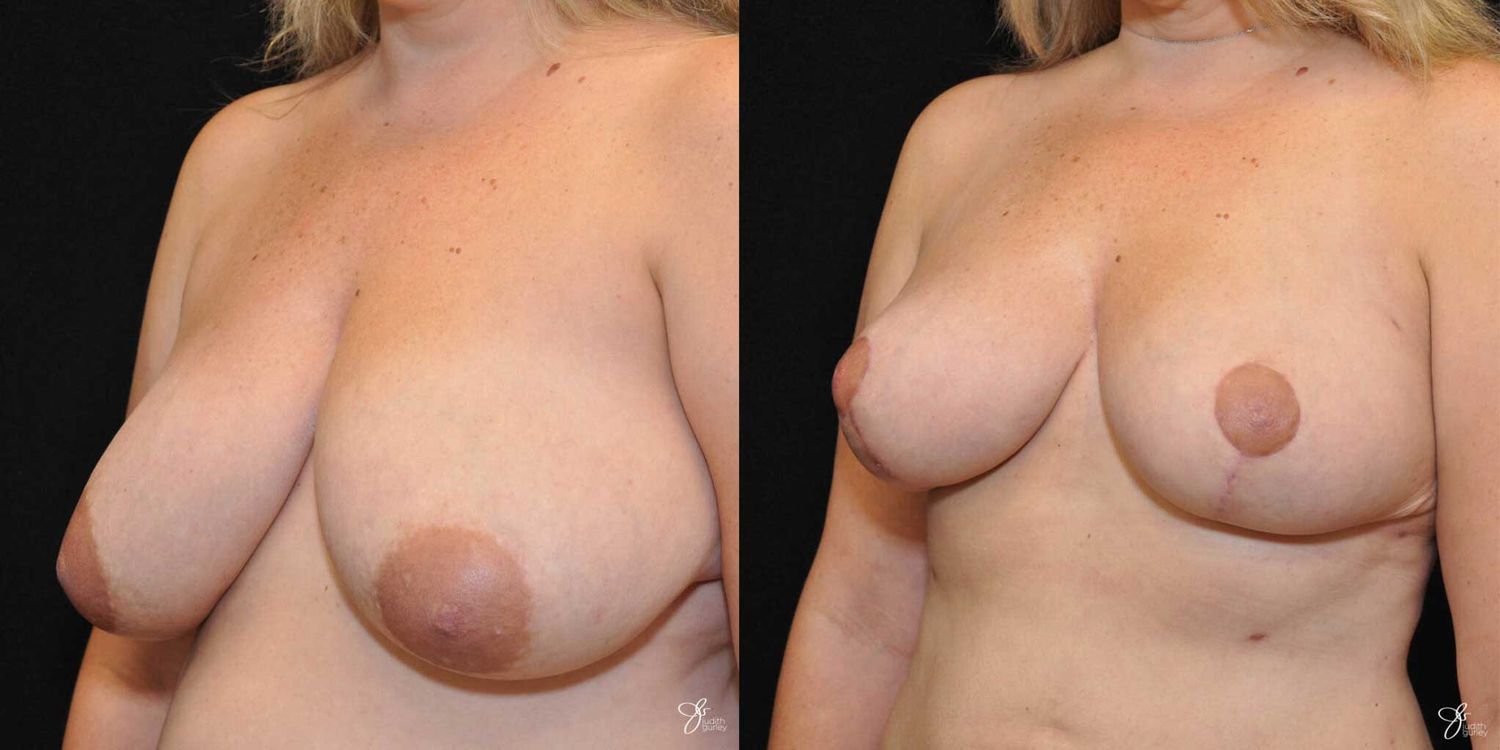 Breast Reduction Before & After