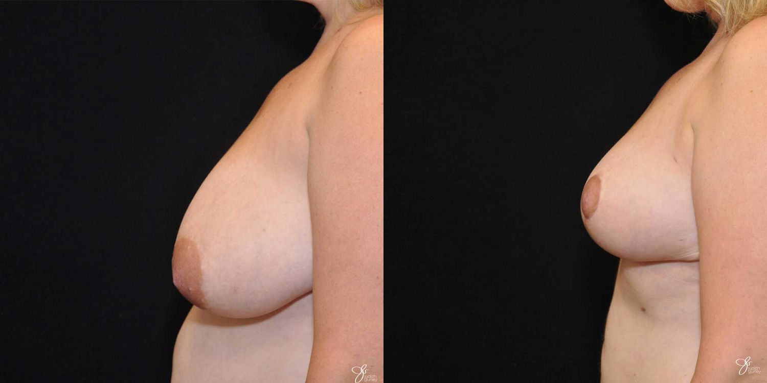 Breast Reduction Before & After