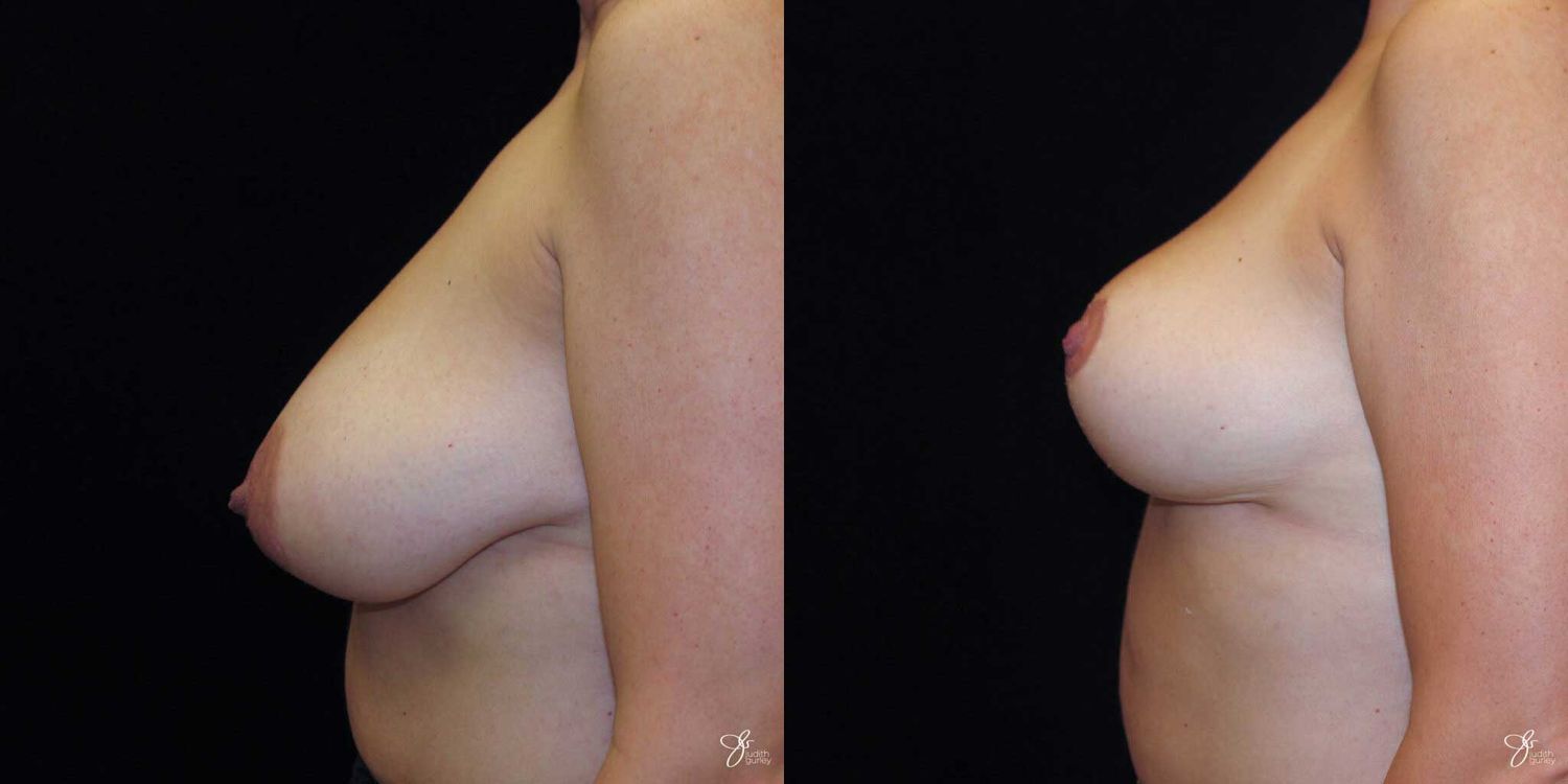 Breast Reduction Before & After