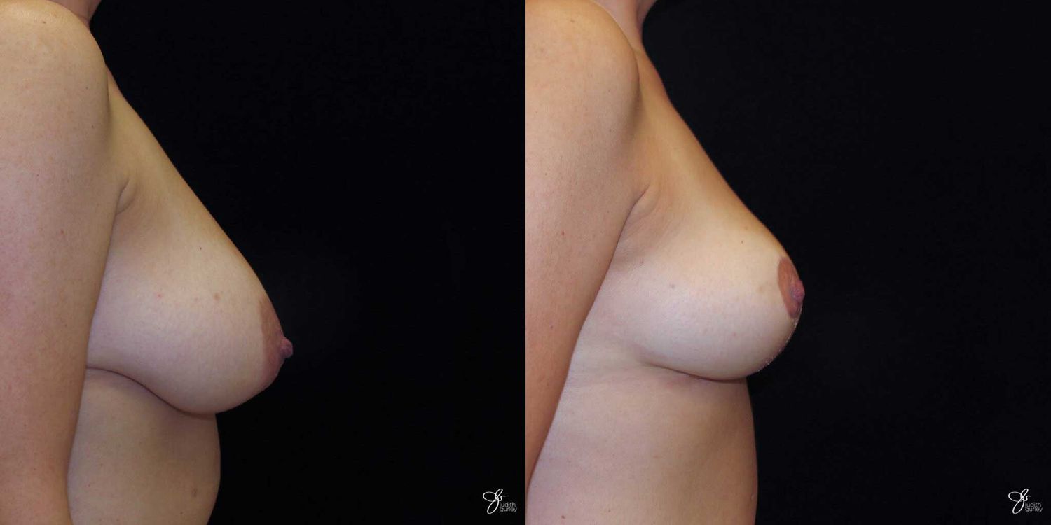 Breast Reduction Before & After