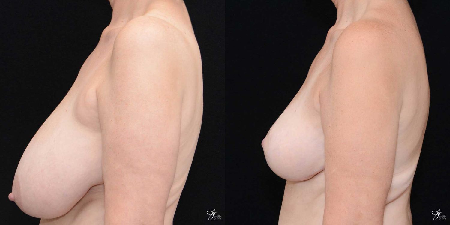 Breast Reduction Before & After